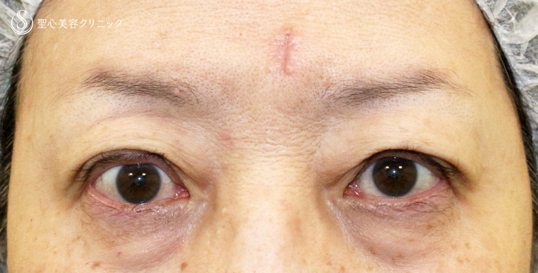 【60代女性・ハードコンタクトによる眼瞼下垂】切らない眼瞼下垂+α法（術直後〜1年後） Before 