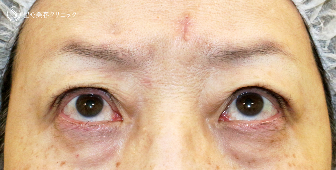 【60代女性・ハードコンタクトによる眼瞼下垂】切らない眼瞼下垂+α法（術直後〜1年後） Before 