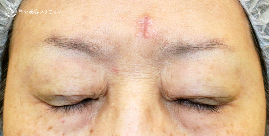 【60代女性・ハードコンタクトによる眼瞼下垂】切らない眼瞼下垂+α法（術直後〜1年後） Before 