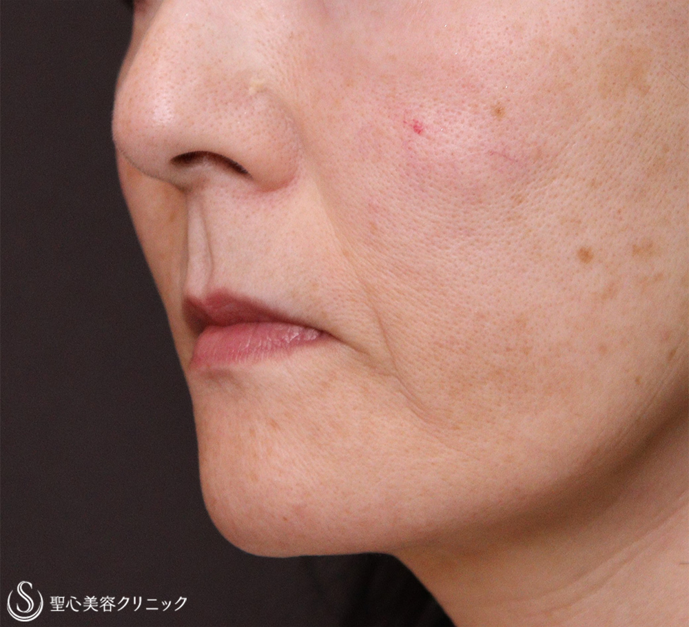 【50代女性・唇の形】スマイルリップ（プレミアム口角挙上術）（術後3週間） Before 