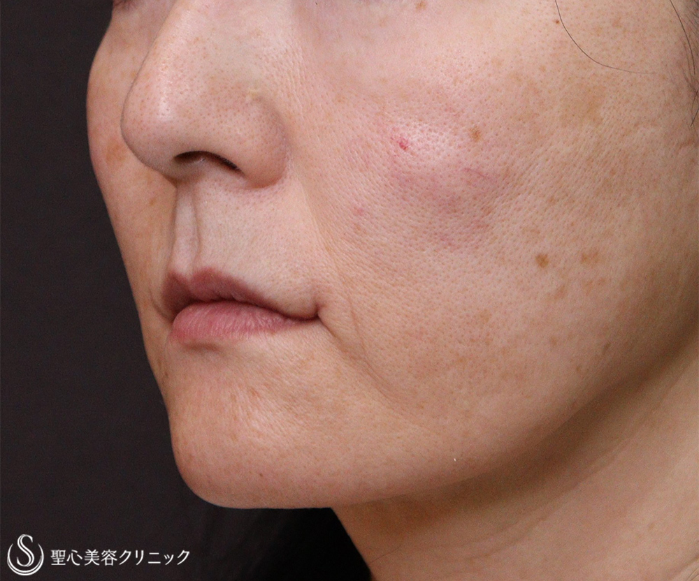 【50代女性・唇の形】スマイルリップ（プレミアム口角挙上術）（術後3週間） After 