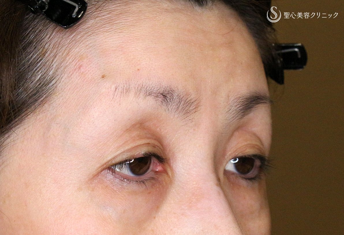 【50代女性・ハードコンタクトによる眼瞼下垂】切らない眼瞼下垂+α法 単独（術直後〜3ヶ月半後） Before 