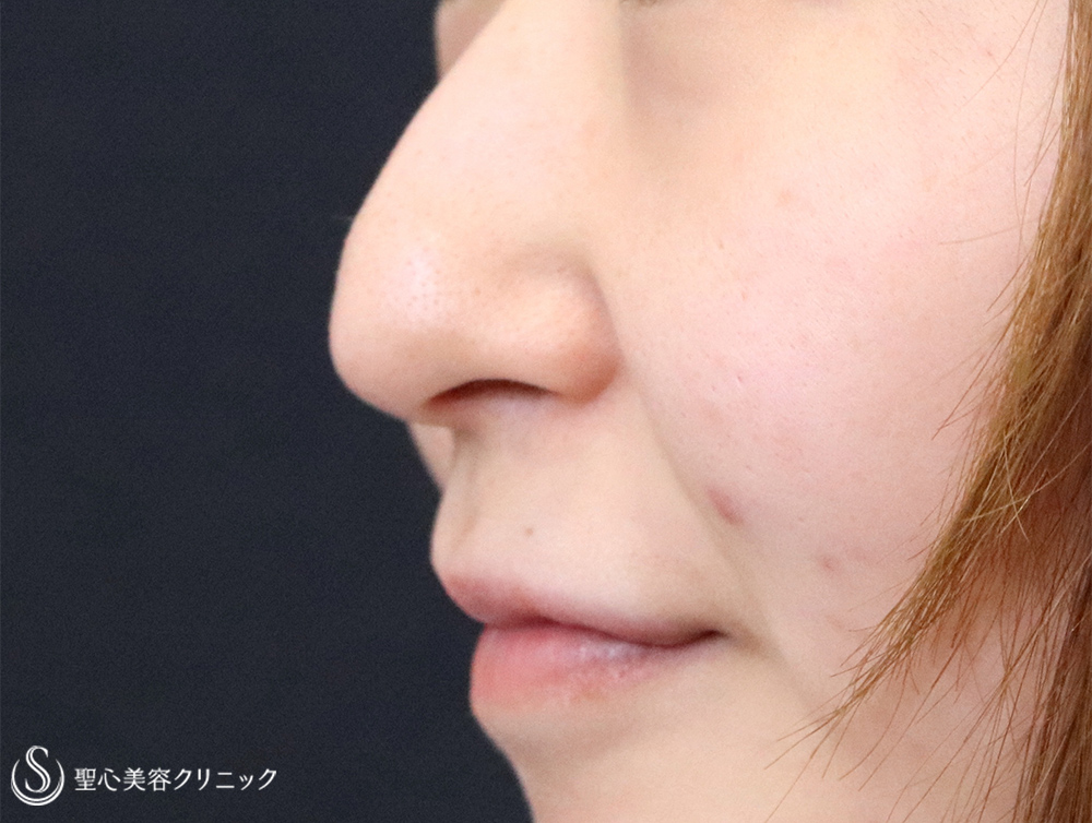 【20代女性・下がった鼻先を修正】鼻尖縮小＋鼻尖形成（耳介軟骨移植）（術後1週間） Before 