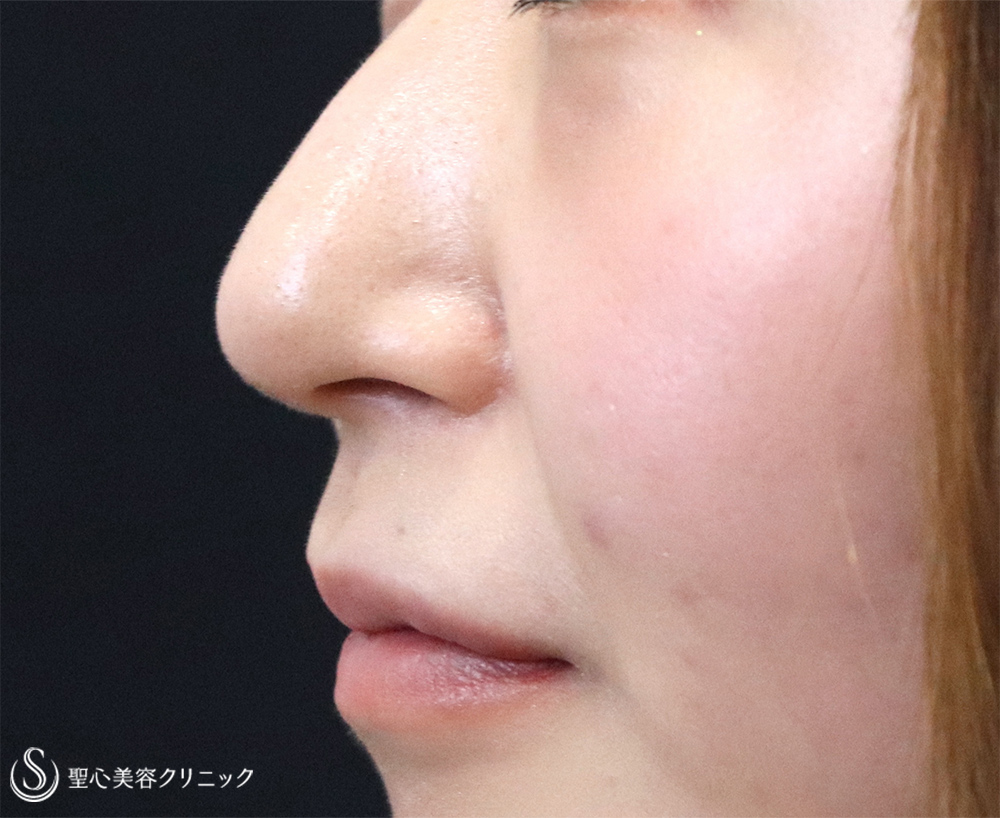 【20代女性・下がった鼻先を修正】鼻尖縮小＋鼻尖形成（耳介軟骨移植）（術後1週間） After 