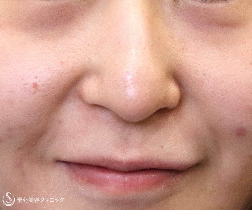 【20代女性・下がった鼻先を修正】鼻尖縮小＋鼻尖形成（耳介軟骨移植）（術後1週間） Before 