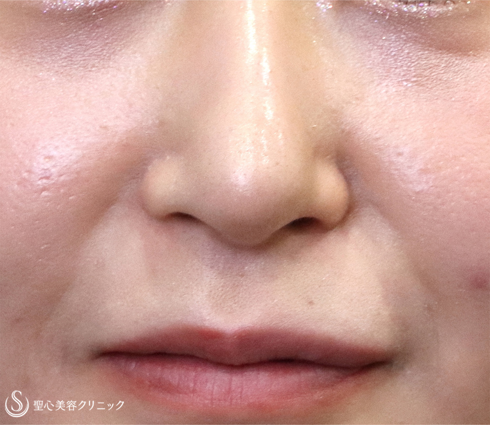 【20代女性・下がった鼻先を修正】鼻尖縮小＋鼻尖形成（耳介軟骨移植）（術後1週間） After 
