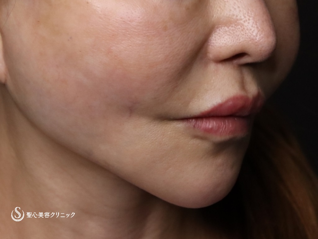 【60代女性・フェイスラインをより綺麗に】アンカーMAX（糸リフト）（手術直後） After 