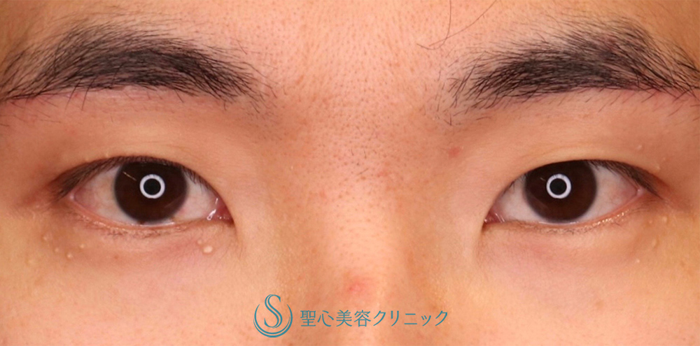 【30代男性・目の上をナチュラルにスッキリ！！】眉下切開法（眉下リフト）（術後4ヶ月） After 