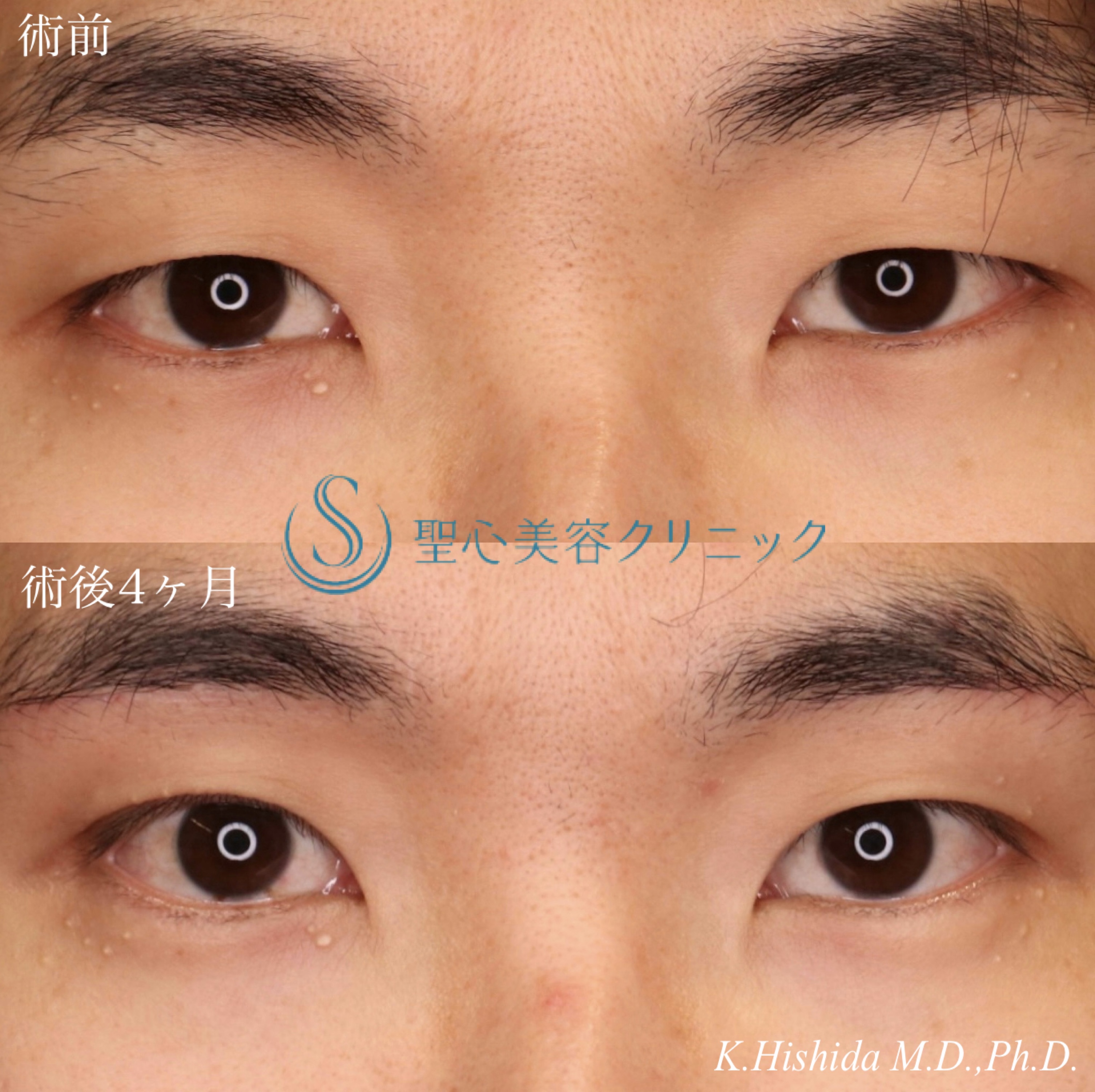 【30代男性・目の上をナチュラルにスッキリ！！】眉下切開法（眉下リフト）（術後4ヶ月） After 