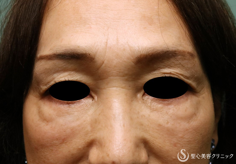 【60代女性・目の下の凹凸、眉間・鼻根のしわ】プレミアムPRP皮膚再生療法（術後5年） Before 