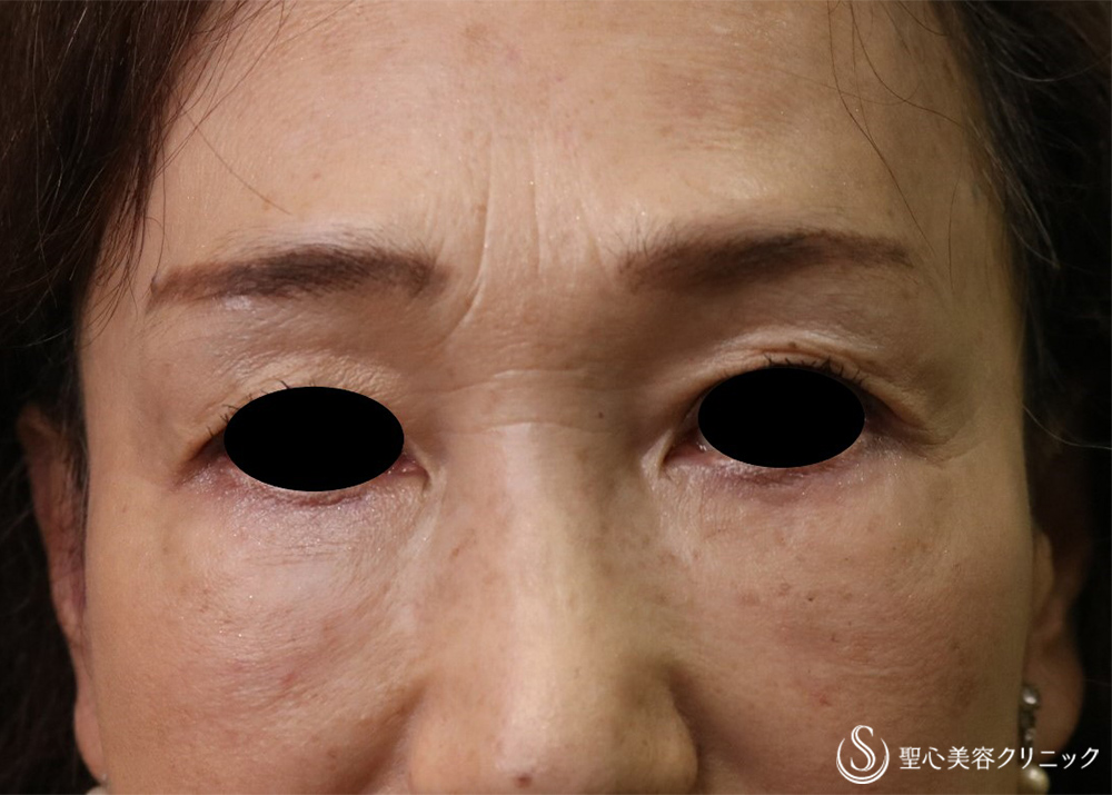 【60代女性・目の下の凹凸、眉間・鼻根のしわ】プレミアムPRP皮膚再生療法（術後5年） Before 