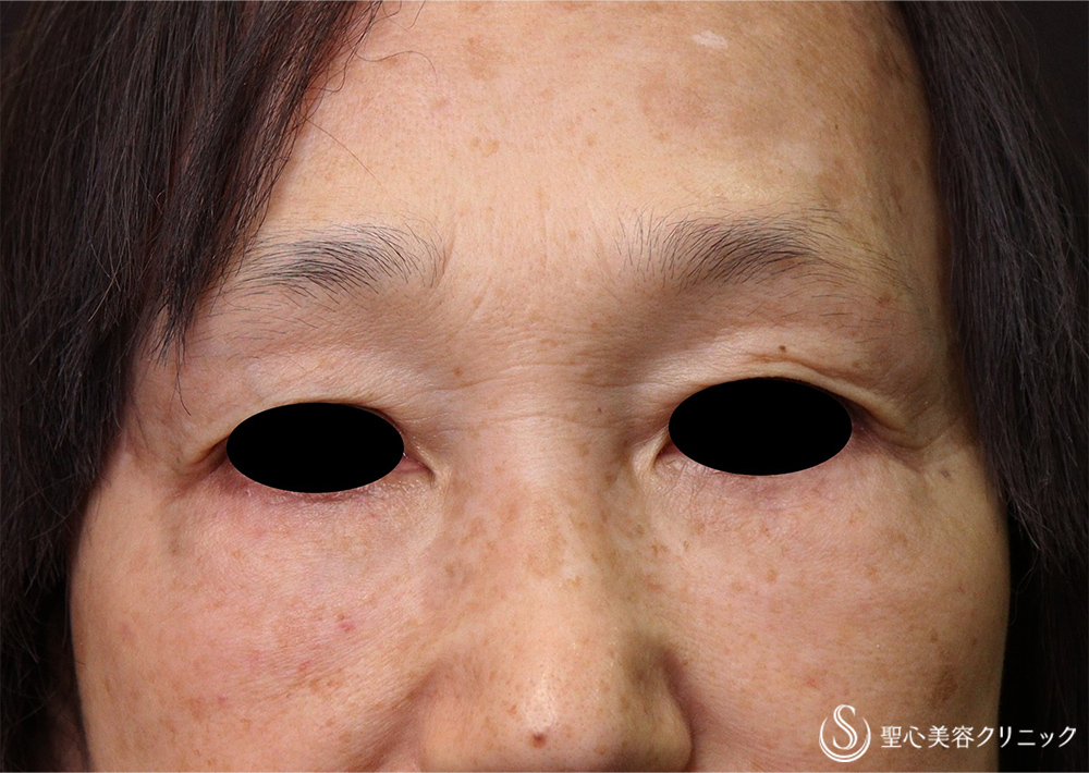 【60代女性・目の下の凹凸、眉間・鼻根のしわ】プレミアムPRP皮膚再生療法（術後5年） After 