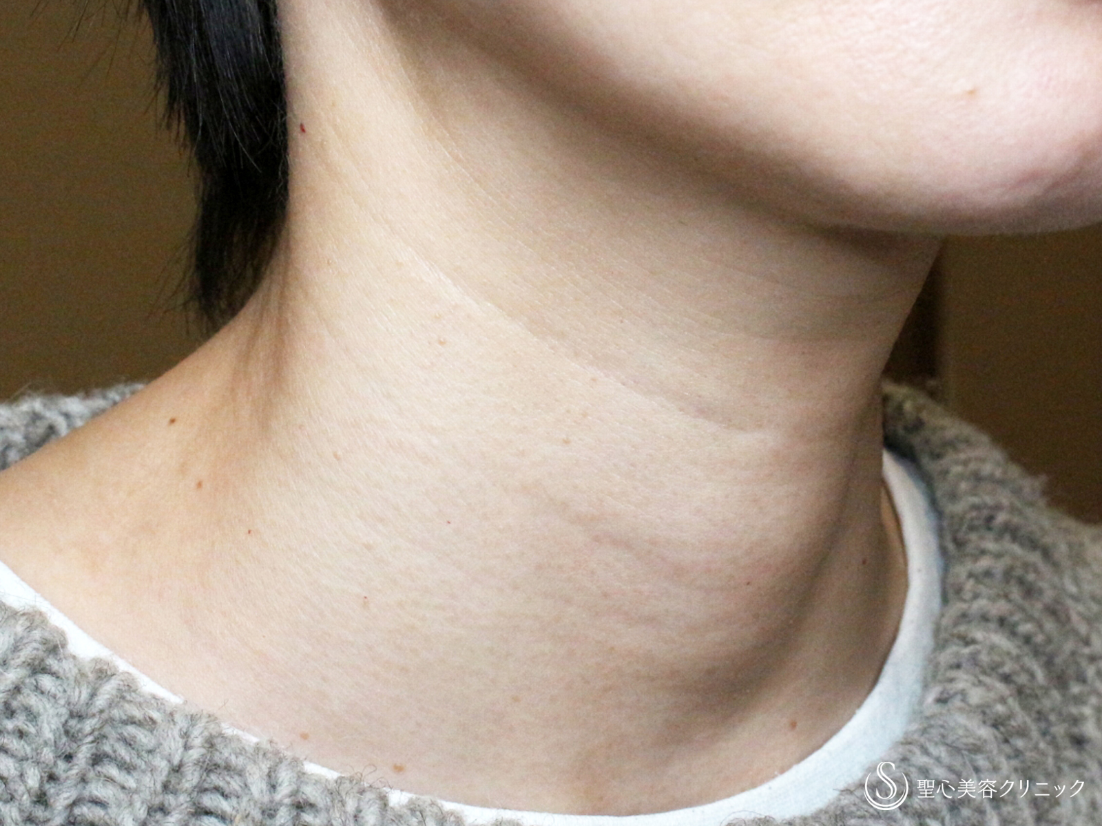 【40代女性・首の横ジワは難しい】プレミアムPRP皮膚再生療法（1年2ヶ月後） Before 