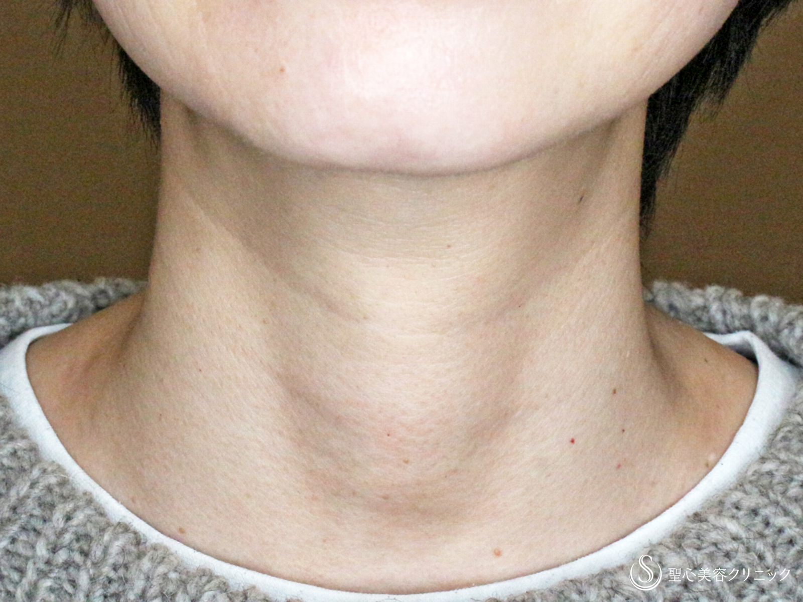 【40代女性・首の横ジワは難しい】プレミアムPRP皮膚再生療法（1年2ヶ月後） Before 