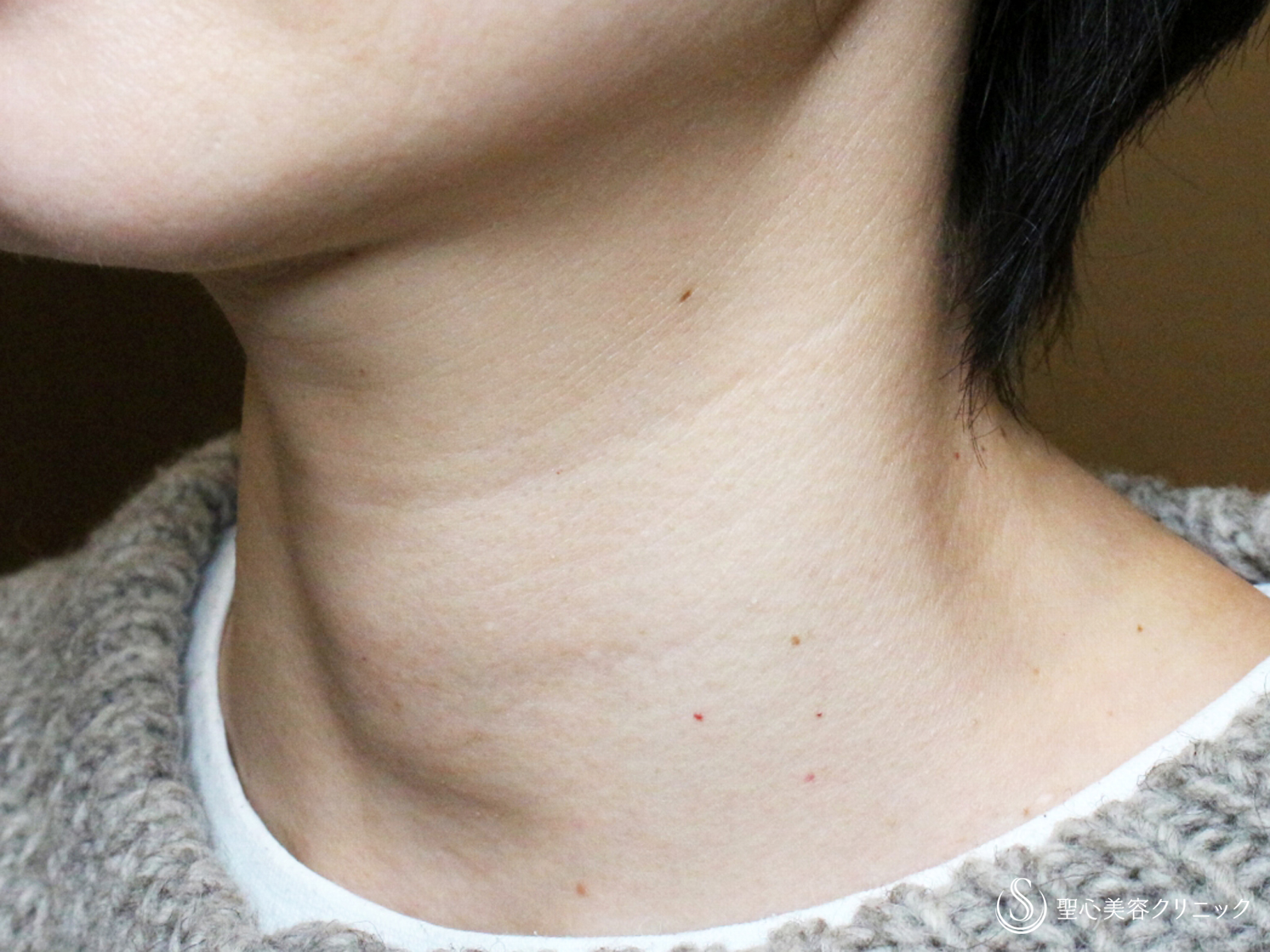 【40代女性・首の横ジワは難しい】プレミアムPRP皮膚再生療法（1年2ヶ月後） Before 