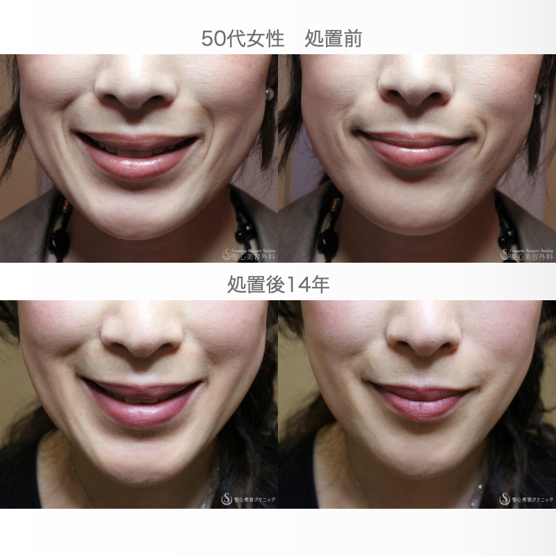 【50代女性・ほうれい線の長期経過】プレミアムPRP皮膚再生療法（14年後） After 