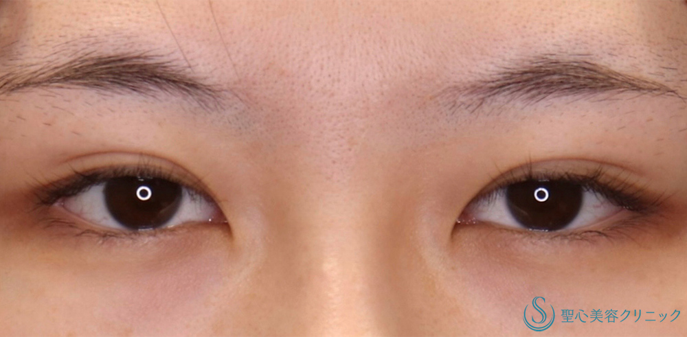 【20代女性・目上切開と二重全切開で綺麗な二重になりたい！！】目上切開＋二重術（全切開）（術後5ヶ月） Before 