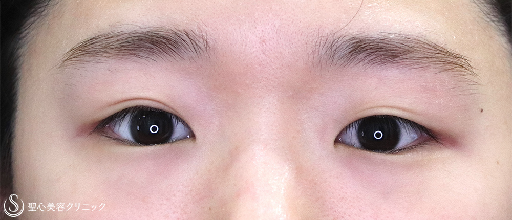 【20代女性・切開法でスッキリ】二重術（切開法）（術後1ヶ月） Before 