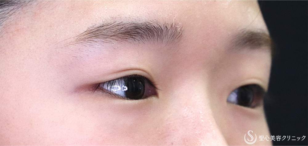 【20代女性・切開法でスッキリ】二重術（切開法）（術後1ヶ月） Before 