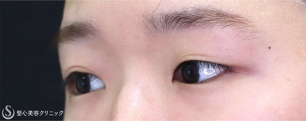【20代女性・切開法でスッキリ】二重術（切開法）（術後1ヶ月） Before 