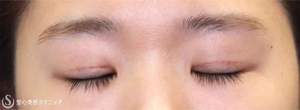 【20代女性・切開法でスッキリ】二重術（切開法）（術後1ヶ月） After 