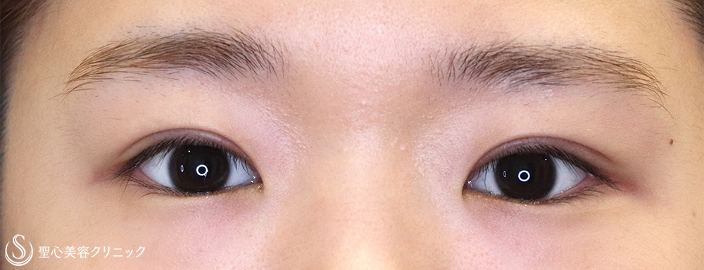 【20代女性・切開法でスッキリ】二重術（切開法）（術後1ヶ月） After 