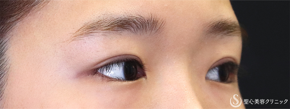 【20代女性・切開法でスッキリ】二重術（切開法）（術後1ヶ月） After 