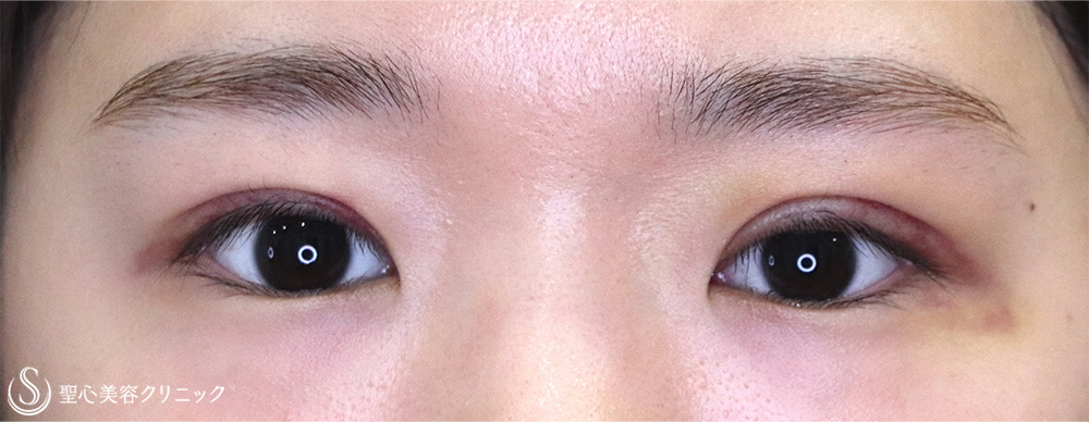 【20代女性・切開法でスッキリ】二重術（切開法）（術後1ヶ月） After 