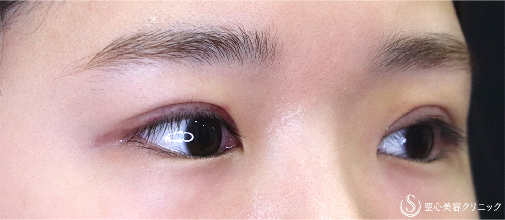 【20代女性・切開法でスッキリ】二重術（切開法）（術後1ヶ月） After 