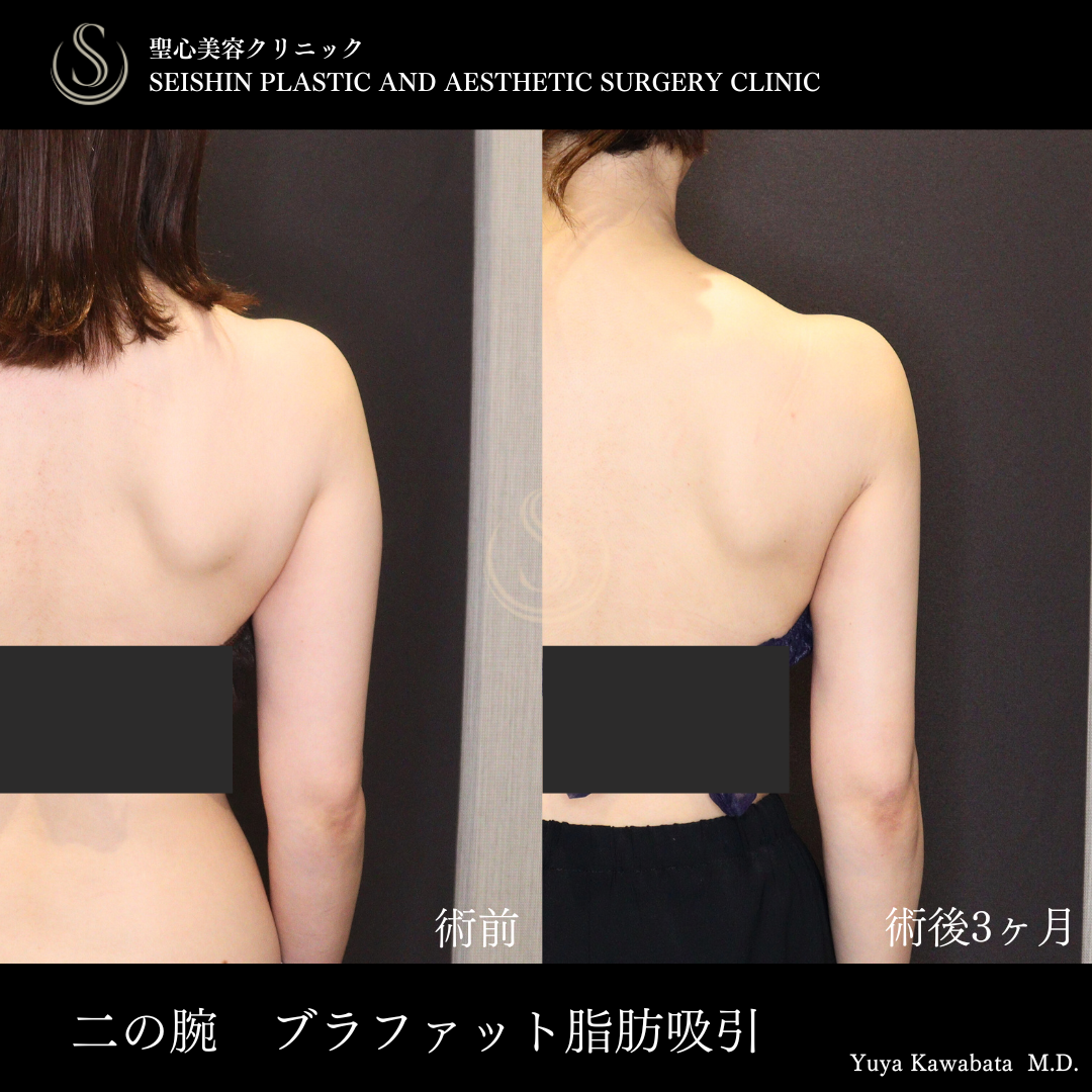 【30代女性・二の腕を細くすらっと】ベイザーリポ2.2脂肪吸引（術後3ヶ月） After 