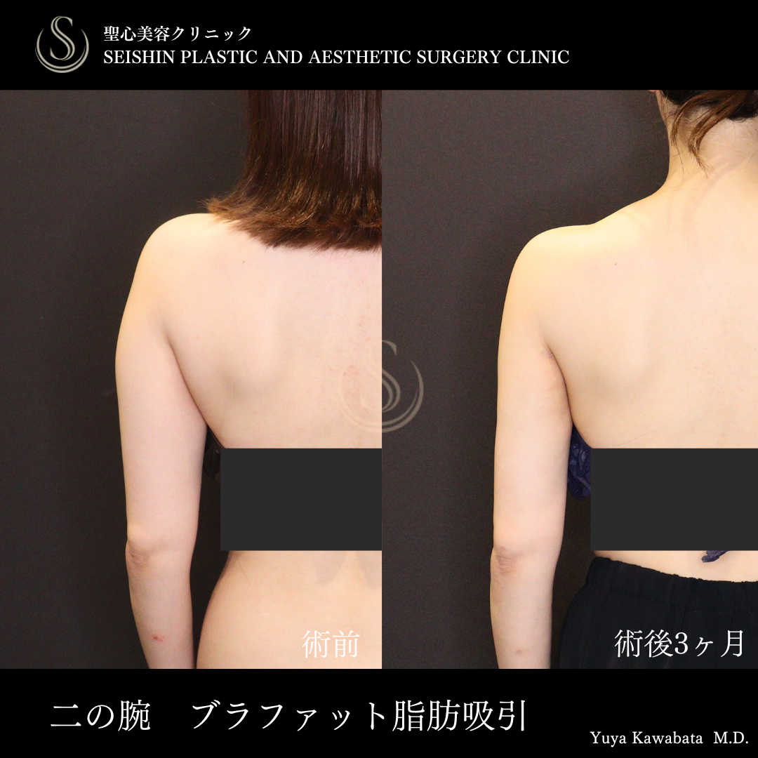 【30代女性・二の腕を細くすらっと】ベイザーリポ2.2脂肪吸引（術後3ヶ月） Before 