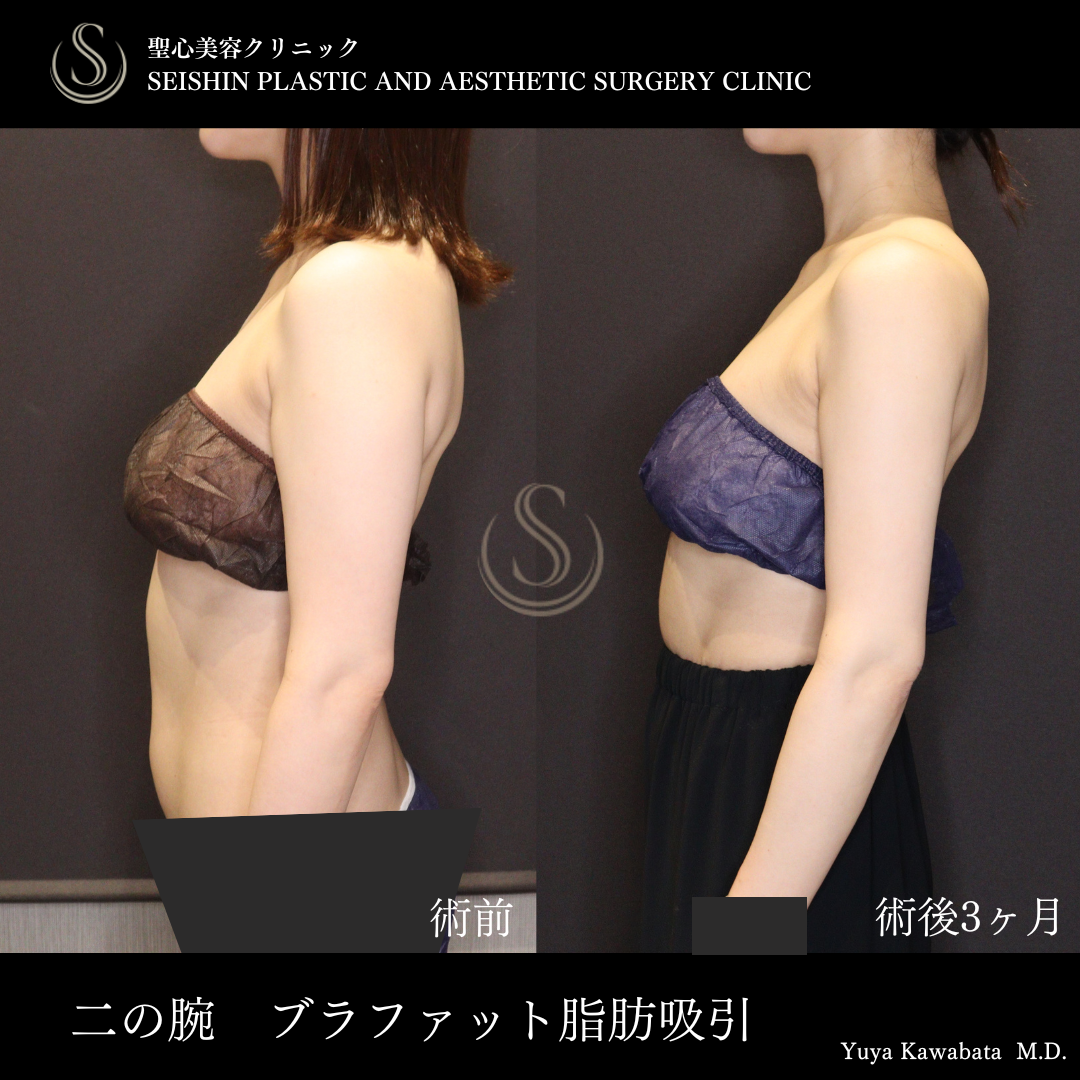 【30代女性・二の腕を細くすらっと】ベイザーリポ2.2脂肪吸引（術後3ヶ月） After 