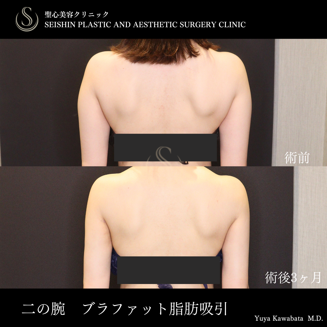 【30代女性・二の腕を細くすらっと】ベイザーリポ2.2脂肪吸引（術後3ヶ月） After 