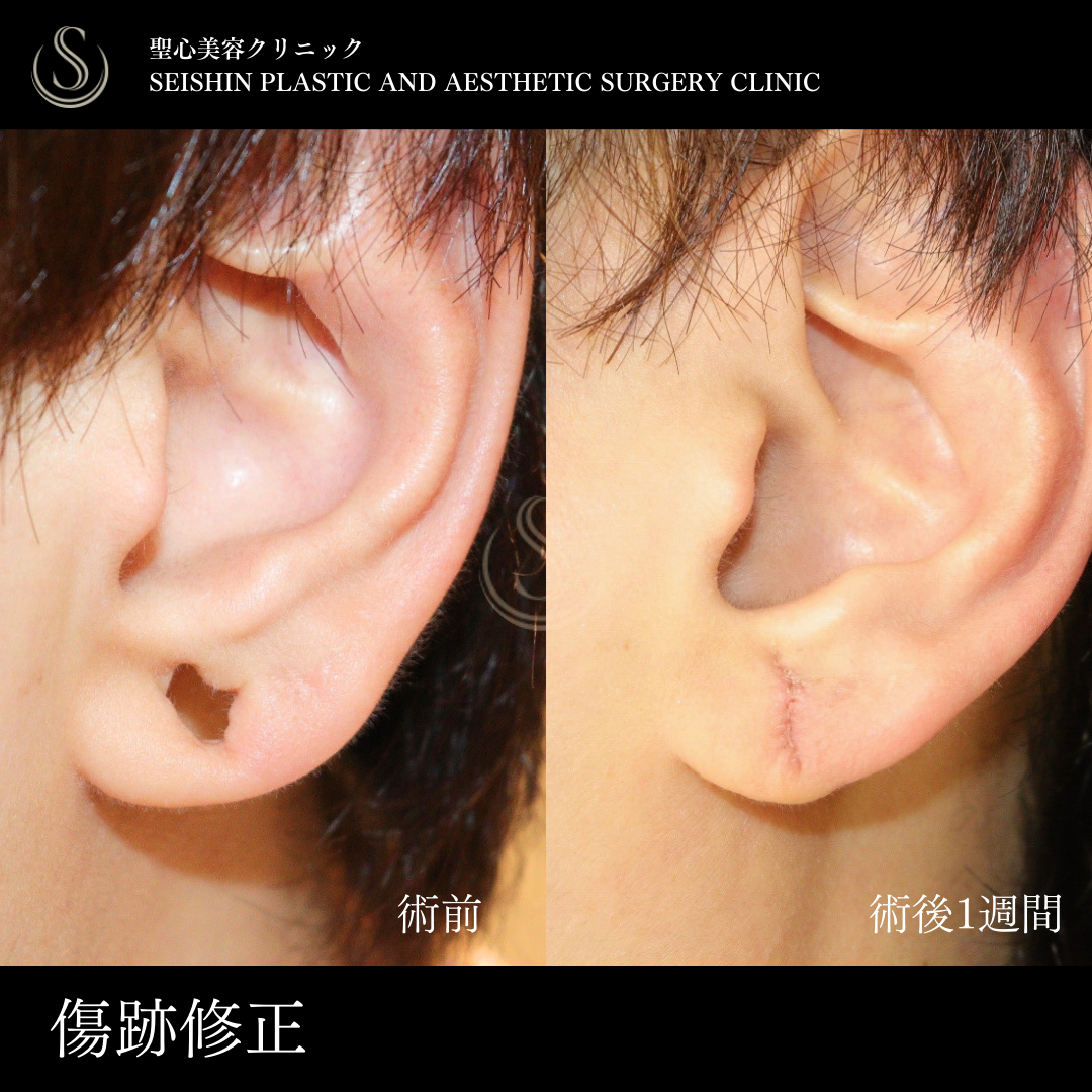 【40代男性・ピアス穴を塞ぐ】傷痕修正（術後1週間） Before 