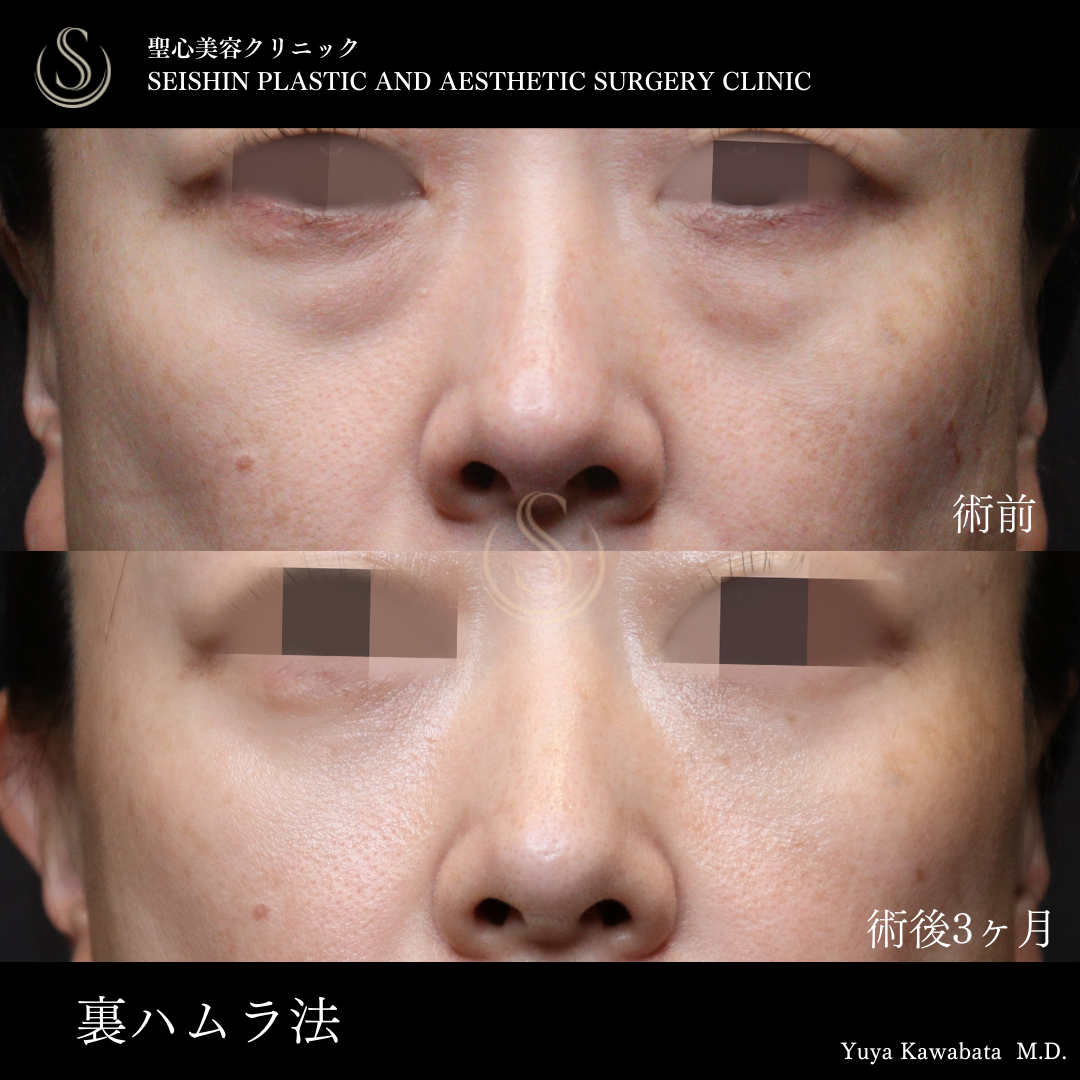 【40代女性・目の下のクマを裏ハムラ法で改善】ハムラ法（術後3ヶ月） Before 