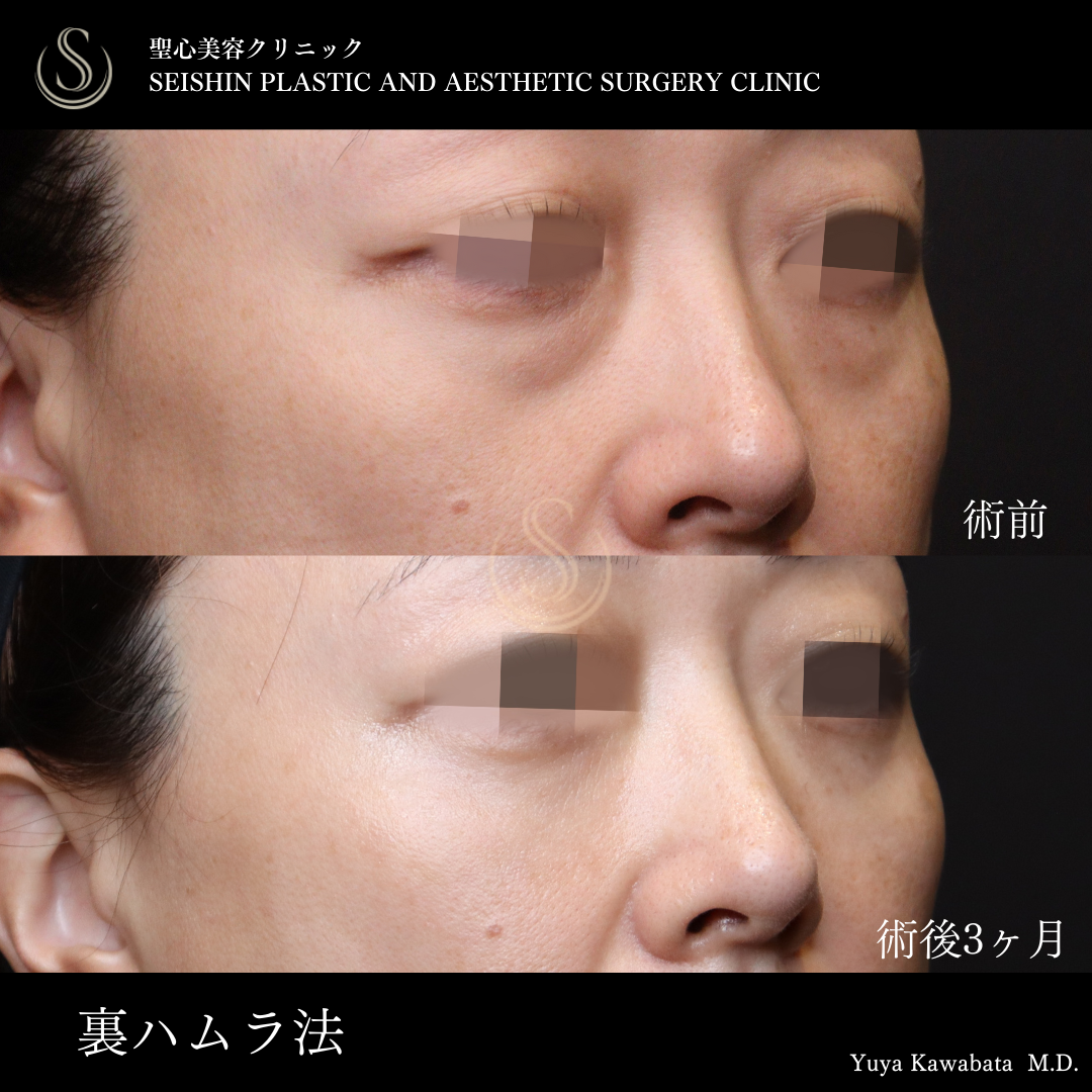 【40代女性・目の下のクマを裏ハムラ法で改善】ハムラ法（術後3ヶ月） After 