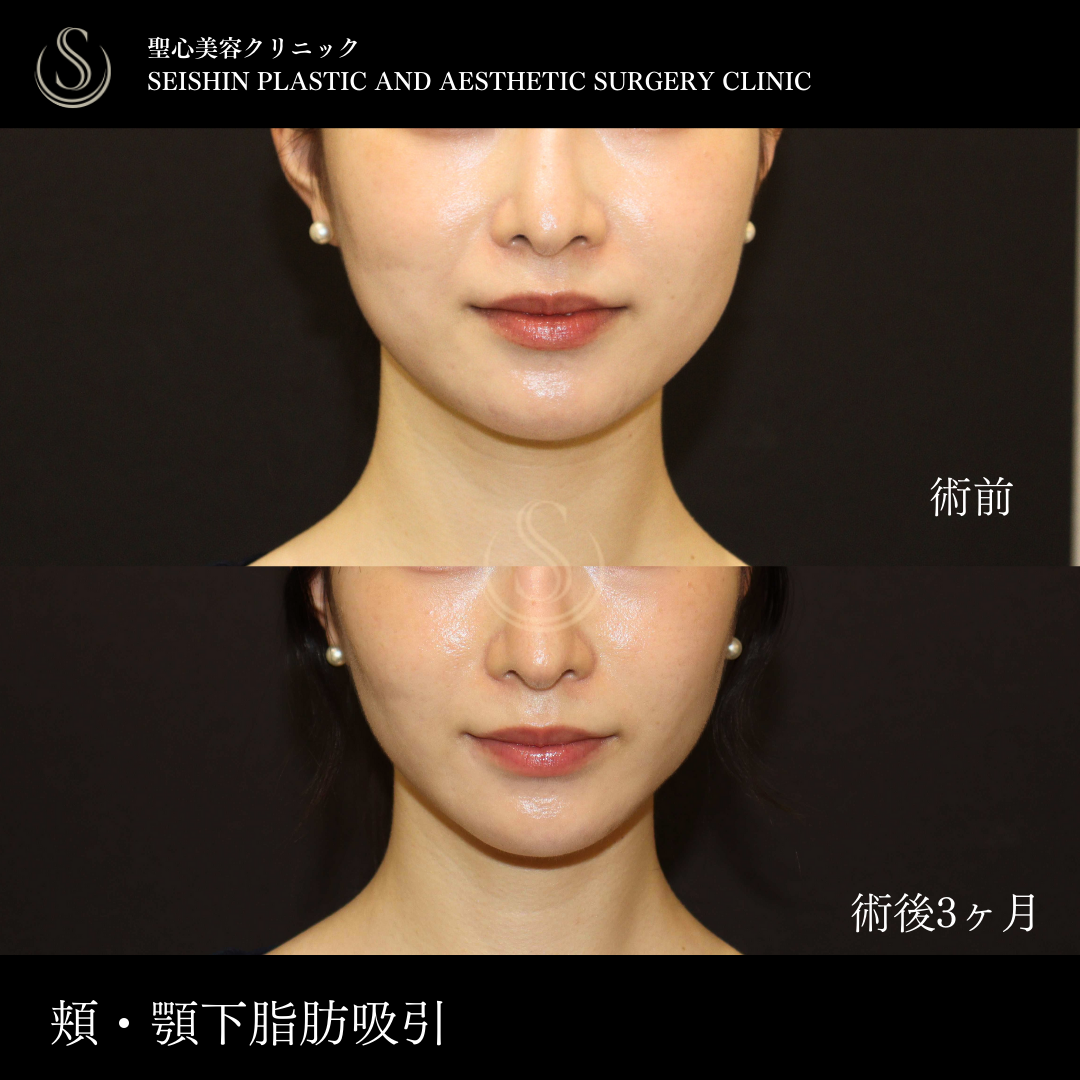 【20代女性・頬の脂肪吸引で理想のフェイスラインに】ベイザーリポ2.2脂肪吸引（術後3ヶ月） Before 