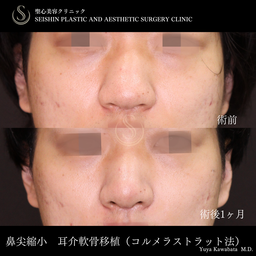 【20代男性・ストラット法で鼻をスッキリ】鼻尖縮小＋鼻尖形成（耳介軟骨移植）＋ストラット法（鼻柱補強術）（術後1ヶ月） Before 