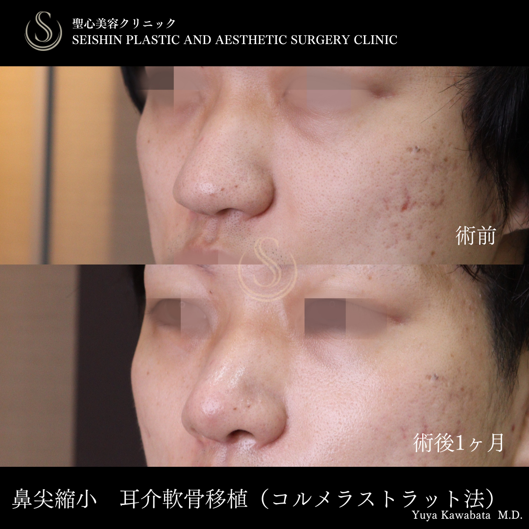 【20代男性・ストラット法で鼻をスッキリ】鼻尖縮小＋鼻尖形成（耳介軟骨移植）＋ストラット法（鼻柱補強術）（術後1ヶ月） After 