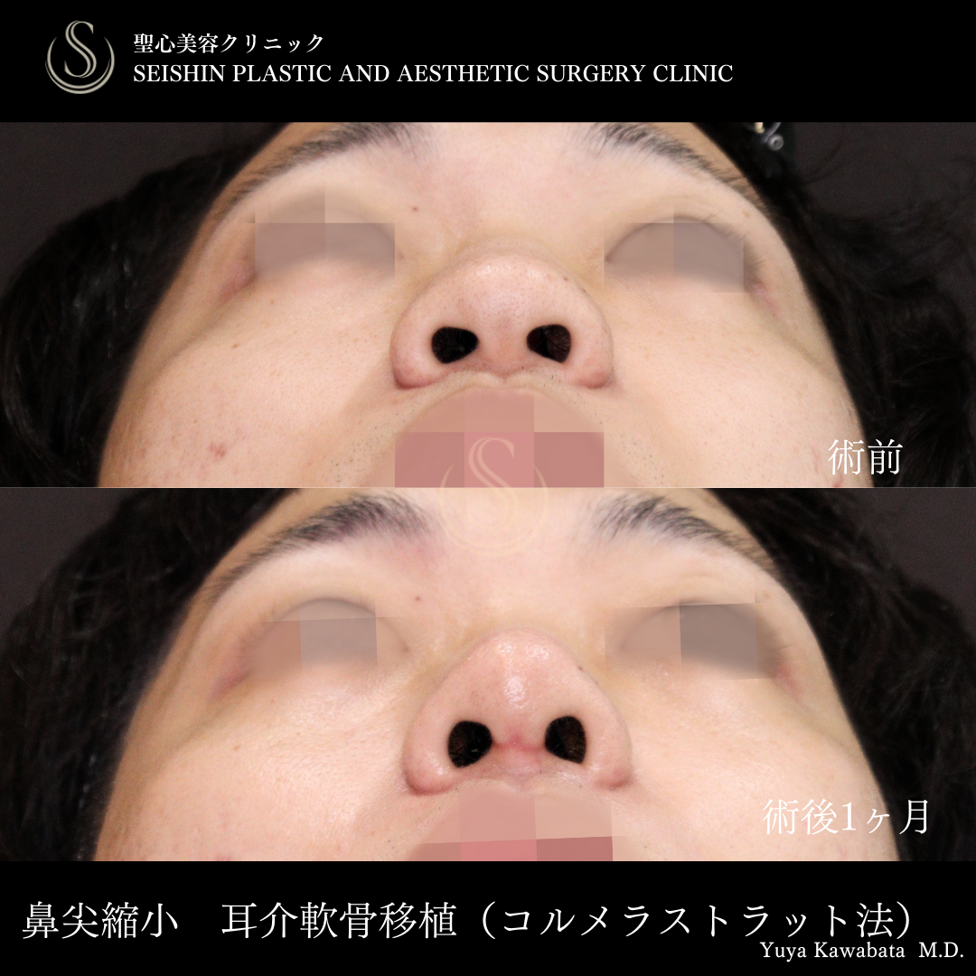 【20代男性・ストラット法で鼻をスッキリ】鼻尖縮小＋鼻尖形成（耳介軟骨移植）＋ストラット法（鼻柱補強術）（術後1ヶ月） After 