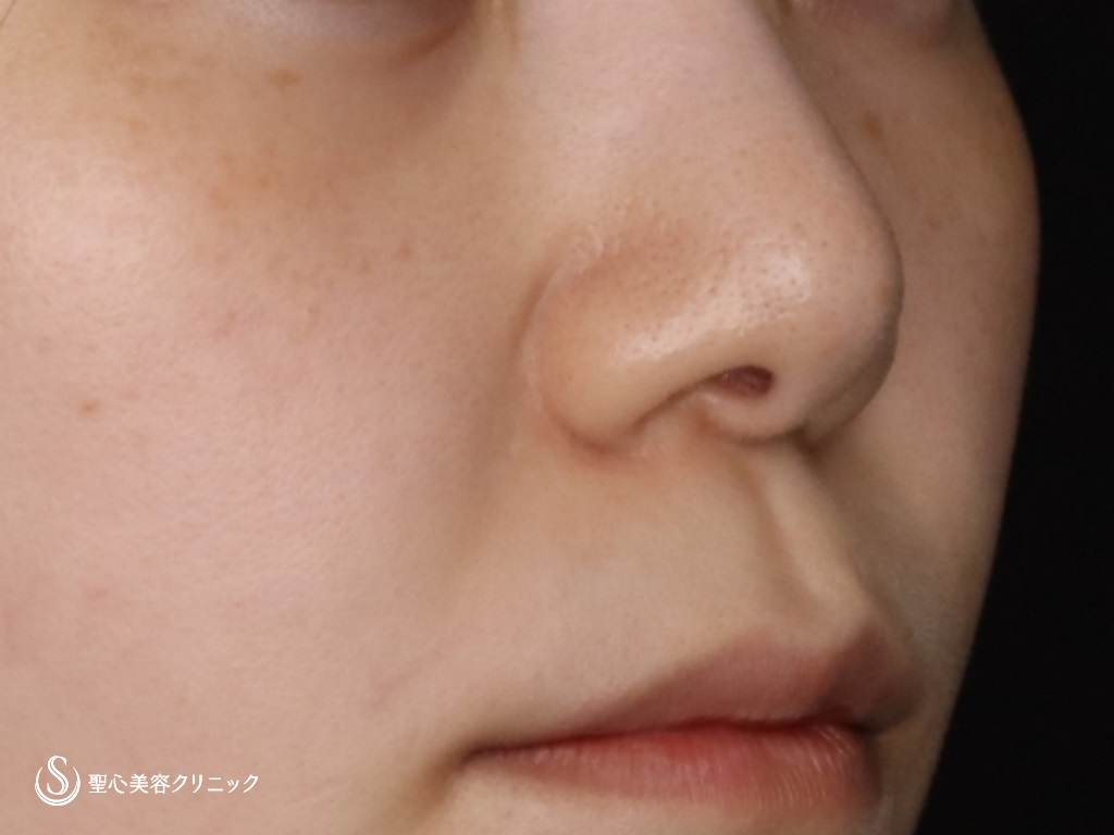 【20代女性・鼻先をより綺麗に】鼻尖形成（耳介軟骨移植）（術後1か月） Before 