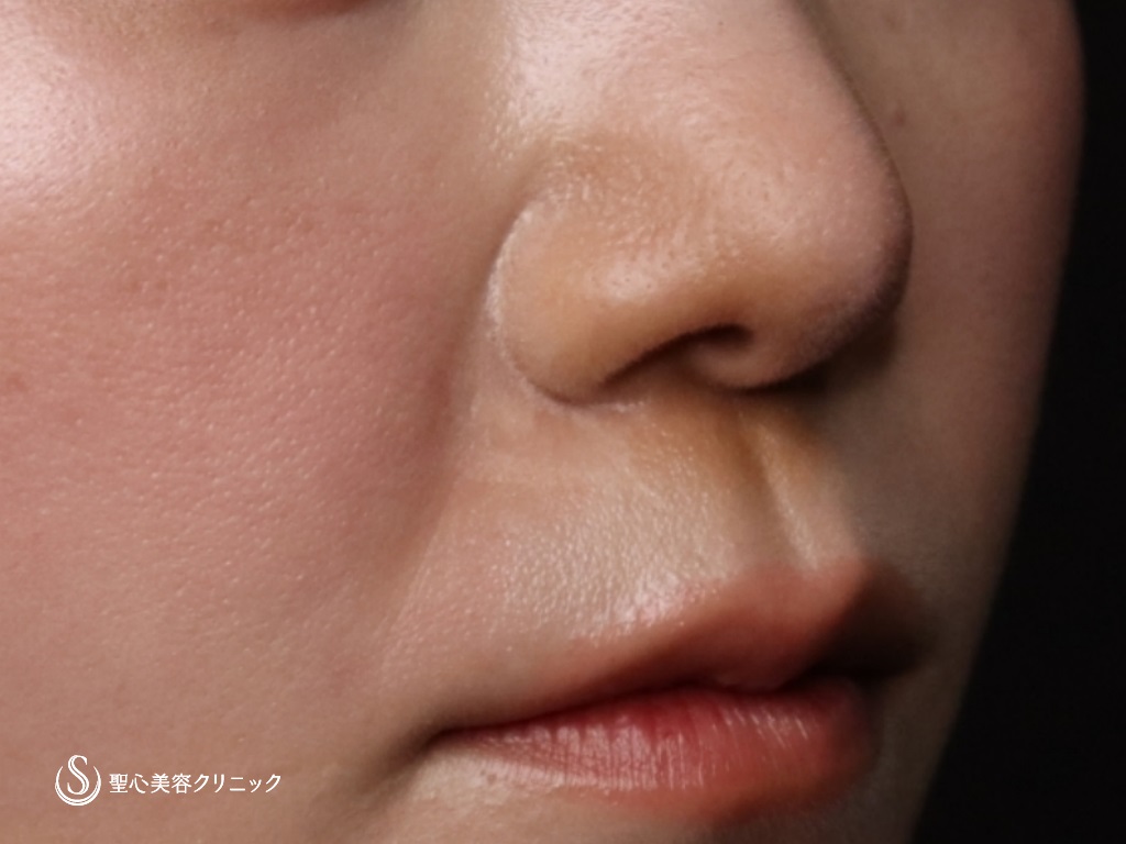 【20代女性・鼻先をより綺麗に】鼻尖形成（耳介軟骨移植）（術後1か月） After 
