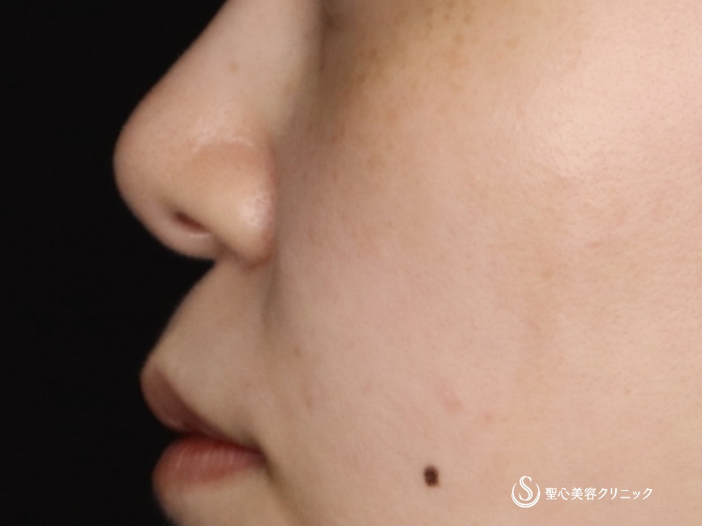 【20代女性・鼻先をより綺麗に】鼻尖形成（耳介軟骨移植）（術後1か月） Before 