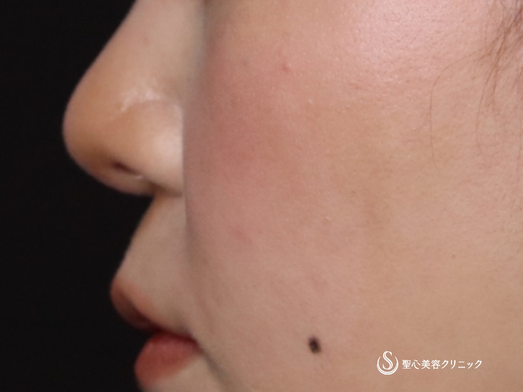 【20代女性・鼻先をより綺麗に】鼻尖形成（耳介軟骨移植）（術後1か月） After 