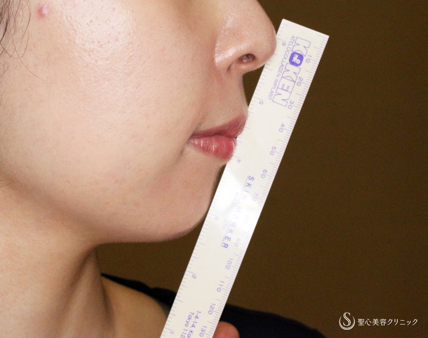 【20代女性・画期的なアゴの注入治療】ヒアルロン酸＆プレミアムPRP皮膚再生療法「ハイブリッド輪郭形成」（直後〜6ヶ月後） After 