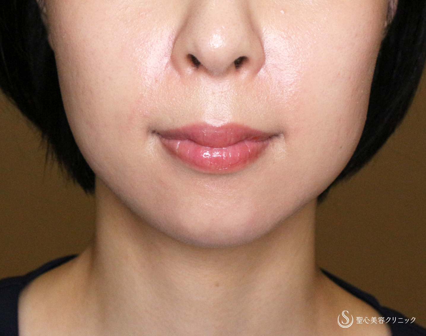 【20代女性・画期的なアゴの注入治療】ヒアルロン酸＆プレミアムPRP皮膚再生療法「ハイブリッド輪郭形成」（直後〜6ヶ月後） After 