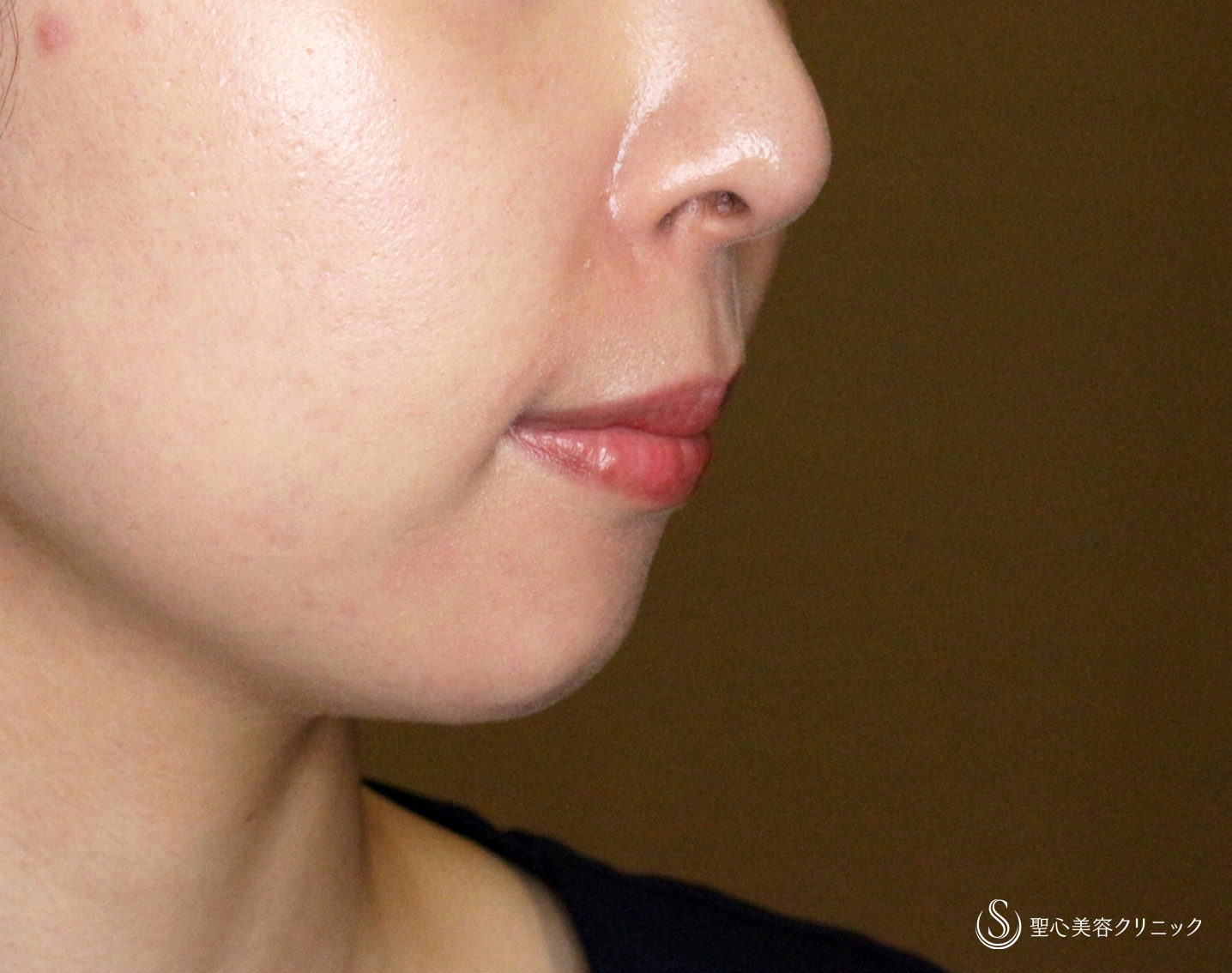 【20代女性・画期的なアゴの注入治療】ヒアルロン酸＆プレミアムPRP皮膚再生療法「ハイブリッド輪郭形成」（直後〜6ヶ月後） After 