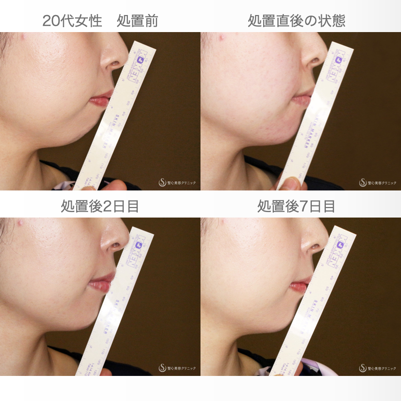 【20代女性・画期的なアゴの注入治療】ヒアルロン酸＆プレミアムPRP皮膚再生療法「ハイブリッド輪郭形成」（直後〜6ヶ月後） Before 