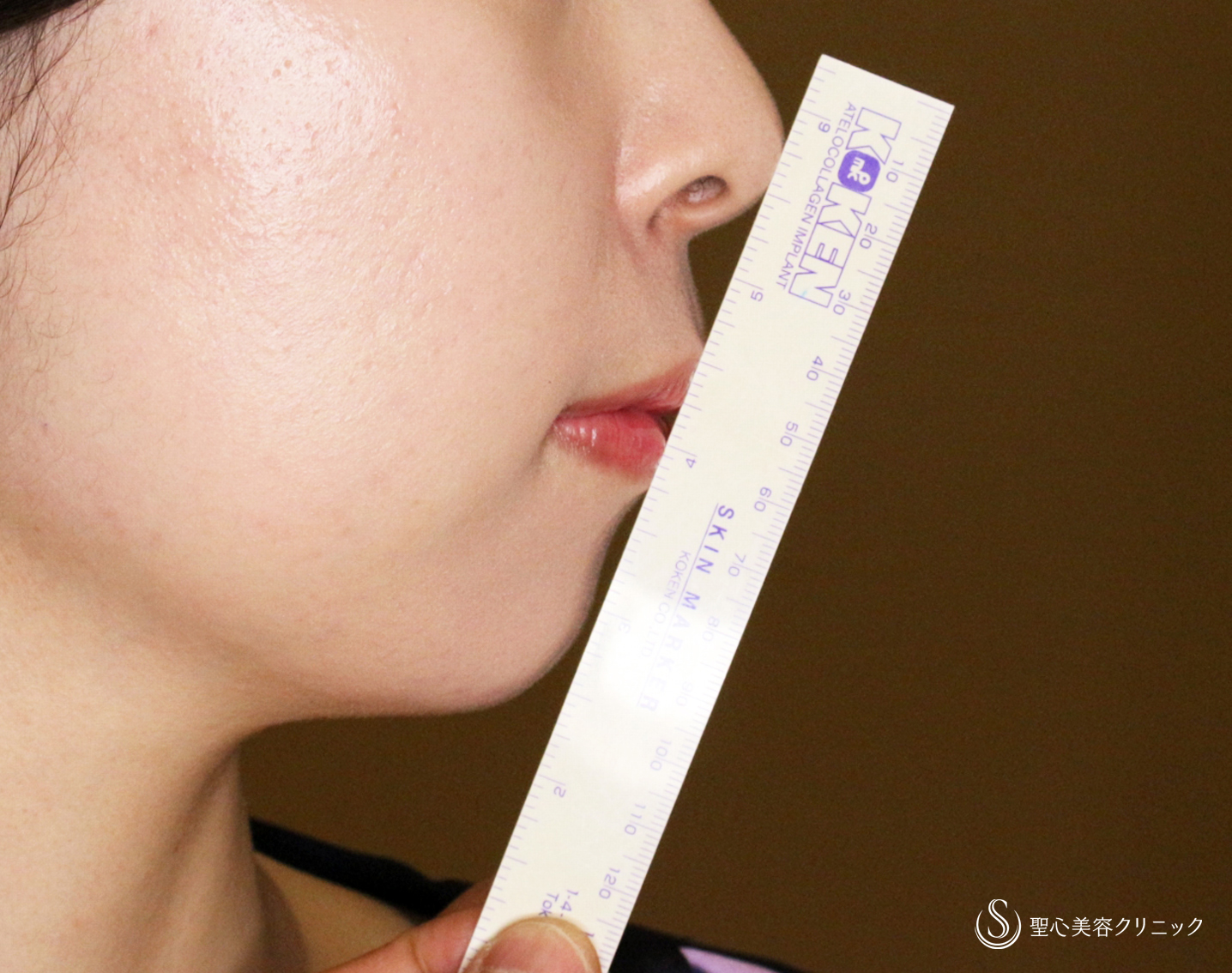 【20代女性・画期的なアゴの注入治療】ヒアルロン酸＆プレミアムPRP皮膚再生療法「ハイブリッド輪郭形成」（直後〜6ヶ月後） After 