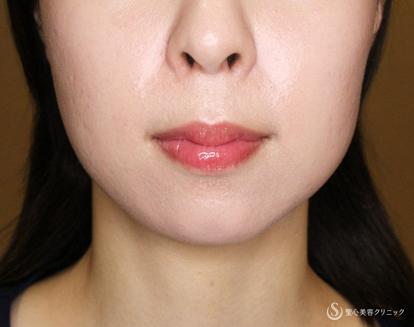【20代女性・画期的なアゴの注入治療】ヒアルロン酸＆プレミアムPRP皮膚再生療法「ハイブリッド輪郭形成」（直後〜6ヶ月後） After 